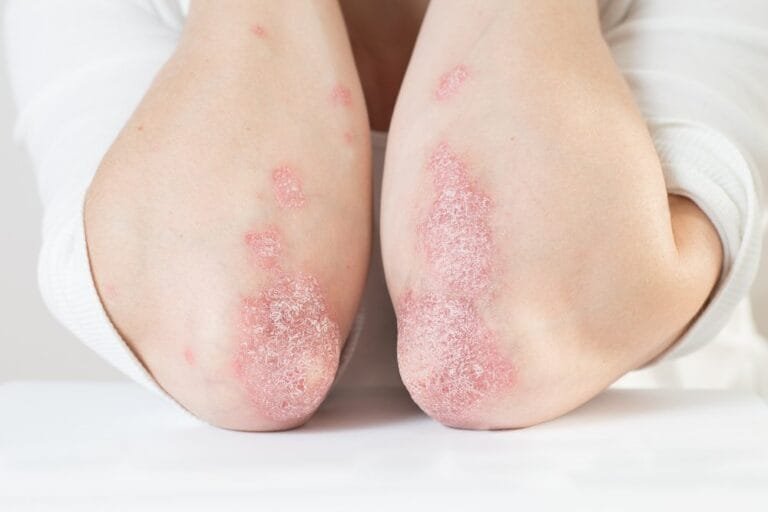 Tratamento da artrite psoriásica